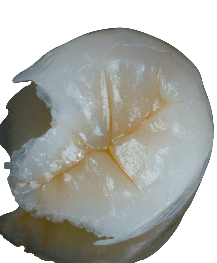 Restaurações Posteriores